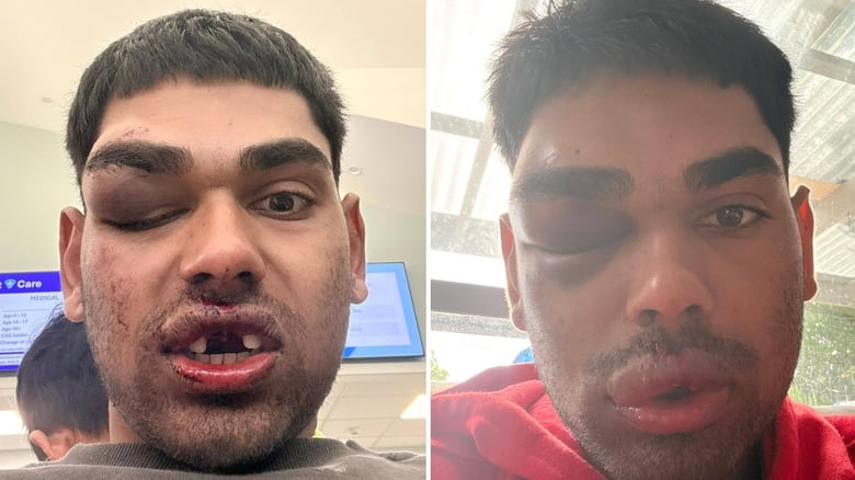 Fijian-indian Man Seriously Injured In An Alleged Attack