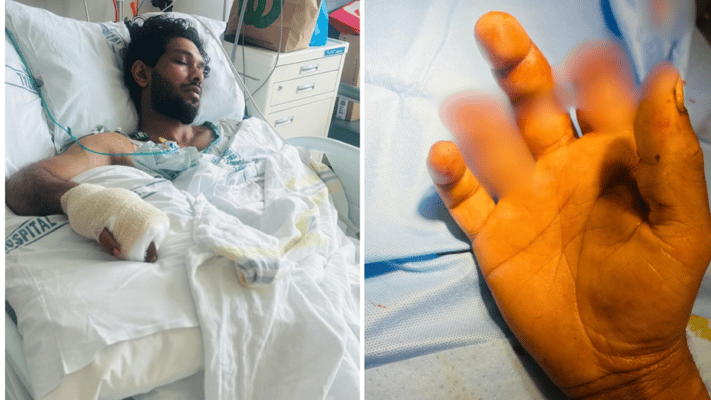 Auckland Man with Crushed Fingers Faces Long Wait for Emergency Care