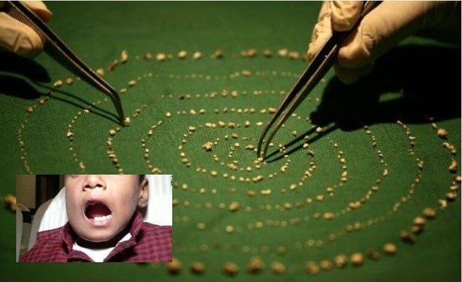 Doctors extract 526 teeth from 7-year-old's mouth in Chennai