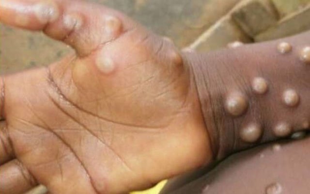 'More monkeypox cases likely': WHO confirms 80 cases in 11 countries