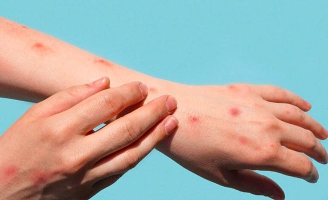 US declares Monkeypox outbreak a Public Health Emergency